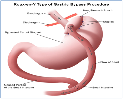 Bariatric Surgery